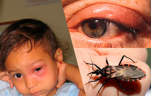 Choroba Chagasa Objawy Przyczyny I Leczenie Medycyna 4489