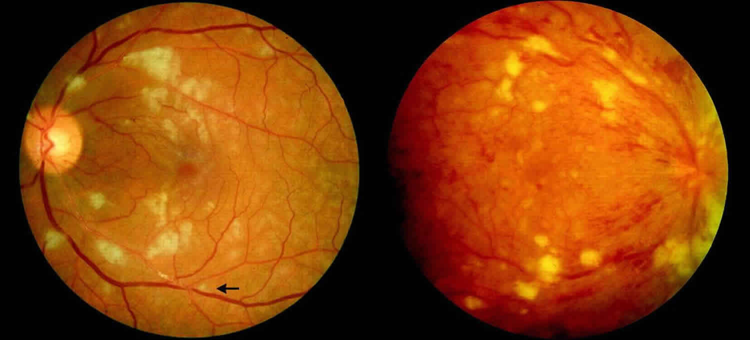 Jak zapalenie wątroby typu B wpływa na twoje oczy