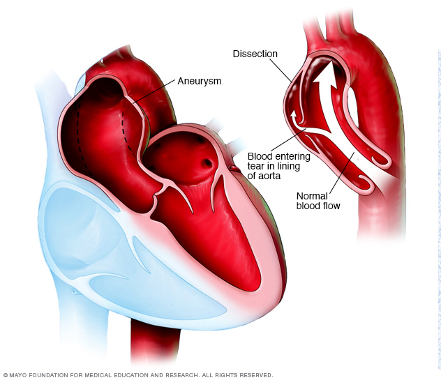 Tętniak aorty i rozwarstwienie aorty