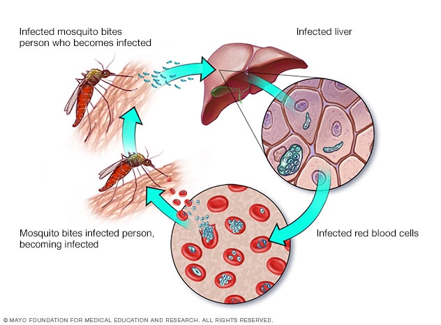 Malaria: przyczyny, objawy i leczenie