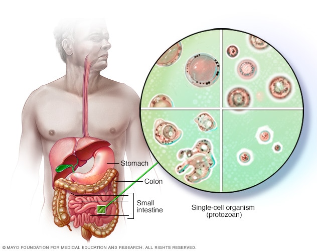 Blastocystis hominis - przyczyny, objawy i leczenie