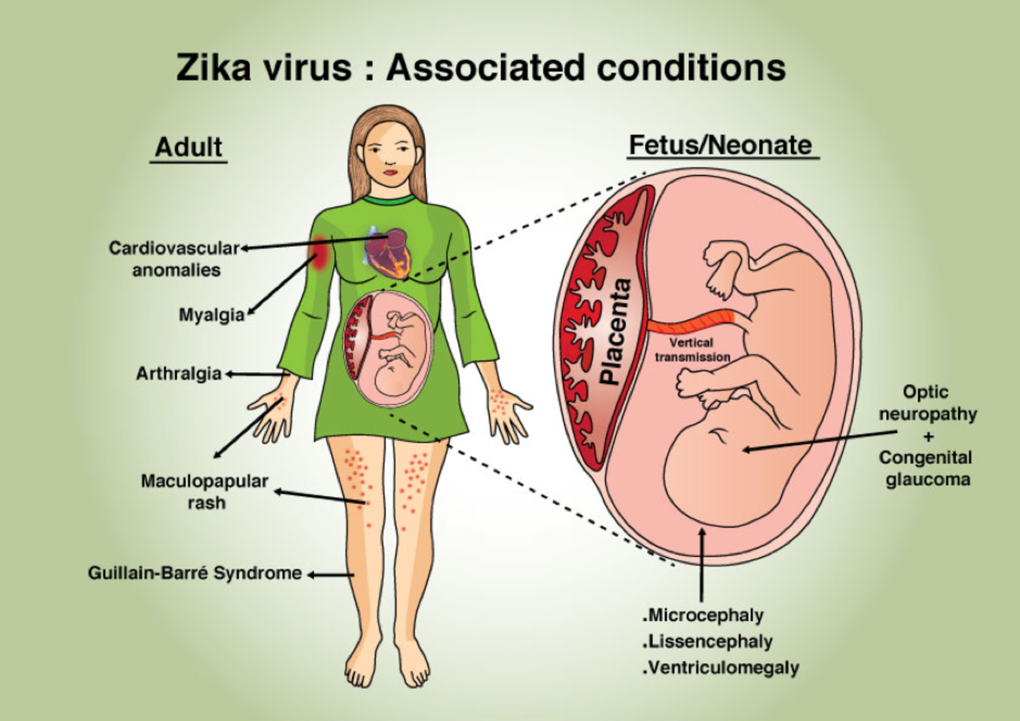 Powikłania związane z infekcją wirusem Zika